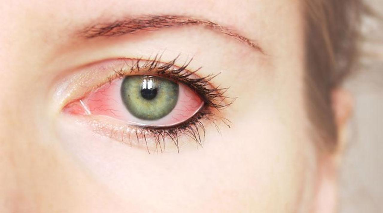 O que você precisa saber sobre conjuntivites?