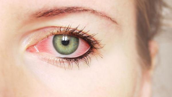 O que você precisa saber sobre conjuntivites?